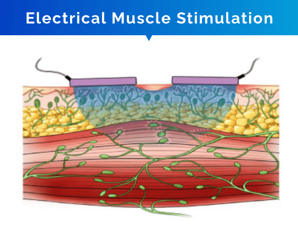 electrical muscle stimulation