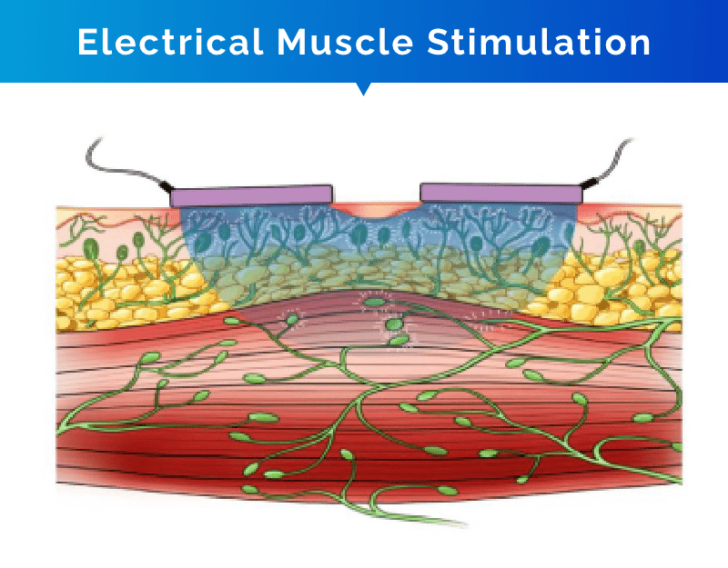 electrical muscle stimulation